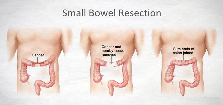 small bowel resection