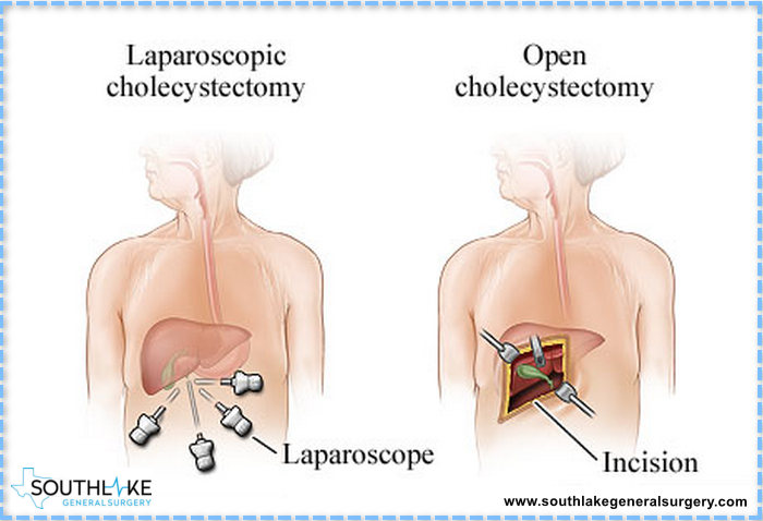 Laparoscopic Gallbladder Surgery Southlake