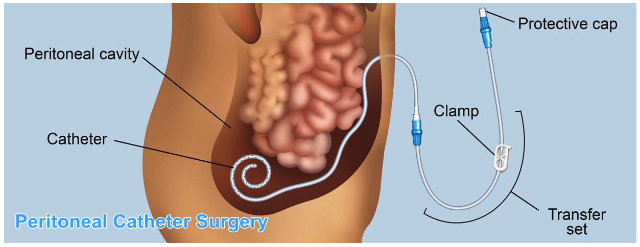 Peritoneal-Catheter-Surgery