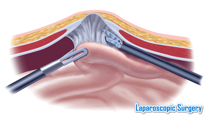 Diagnostic Laparoscopy