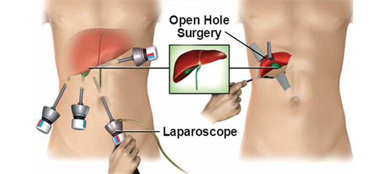 open vs laparoscopic surgery