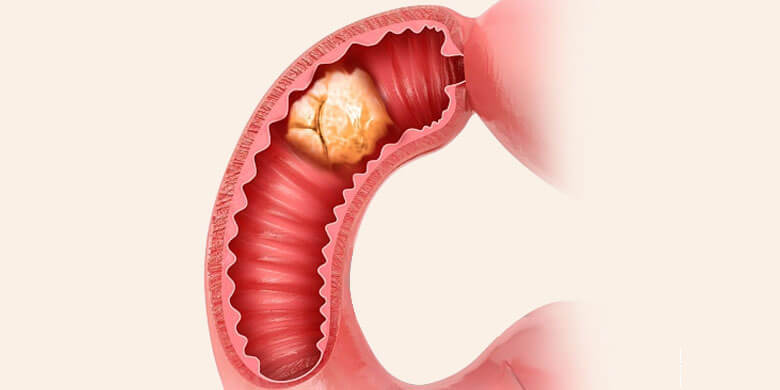 small intestine cancer