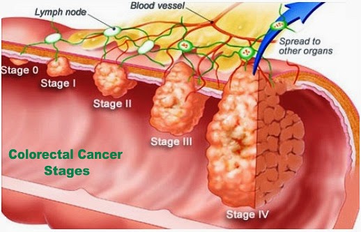 colon-cancer