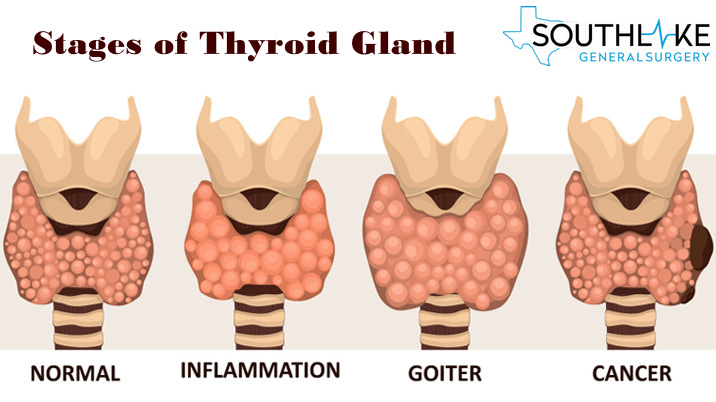 stages of throid Gland