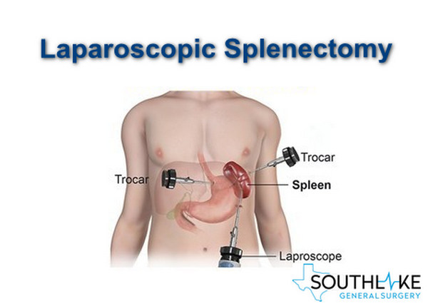 splenectomy for wandering spleen