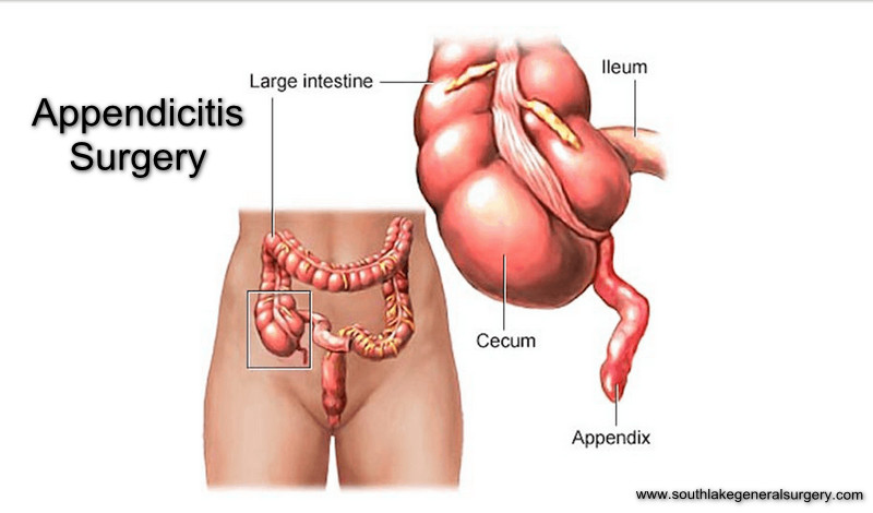 Donde esta la apendicitis mujer