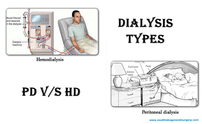 Peritoneal-dialysis-hemodialysis