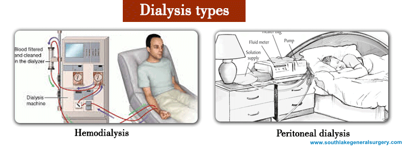 define-dialysis-peritoneal-dialysis-vs-hemodialysis-complications-of-pd