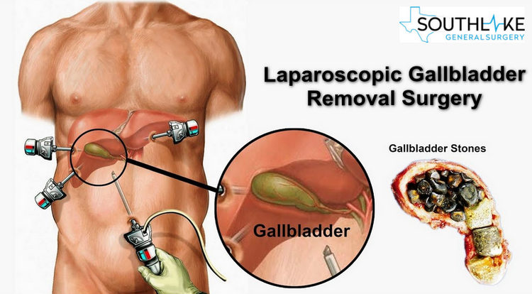 laparoscopic gallbladder removal Southlake General Surgery