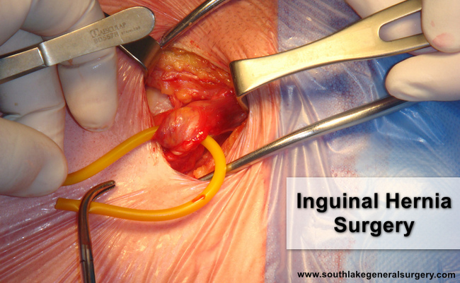 Inguinal Hernia Cause Symptom Treatment Southlake General Surgery