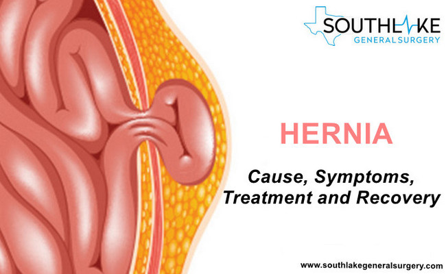 Hernia-cause-symptoms-treatment