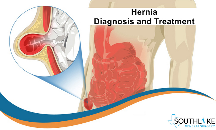 hernia-diagnosis-treatment