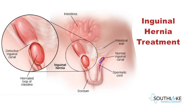 Treat Inguinal Hernia Without Surgery The Five Best Ways To Do It