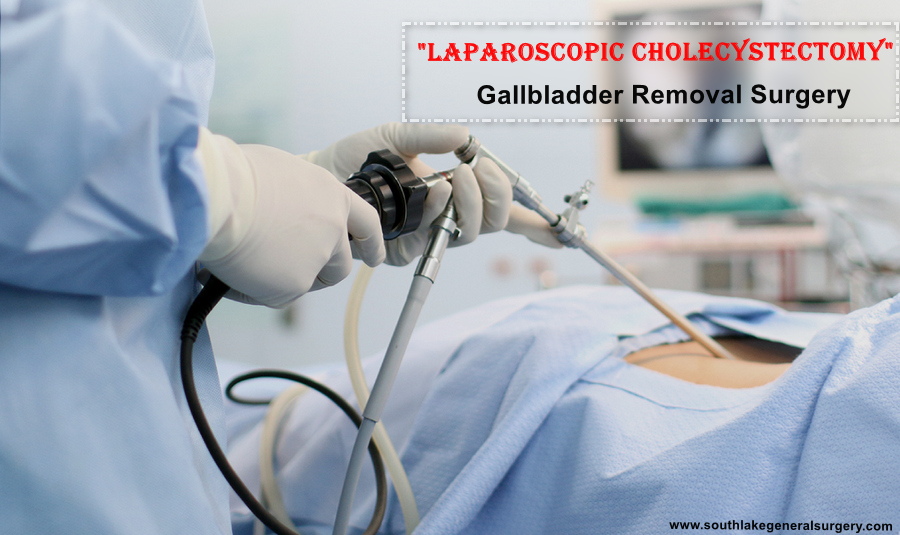 Laproscopic-gallbladder-surgery