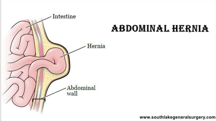 abdominal hernia surgery southlake