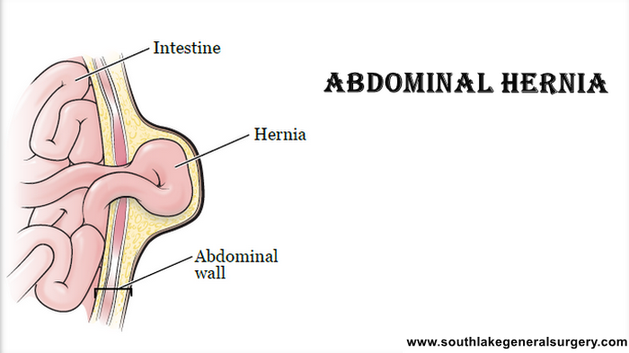 abdominal hernia in adults