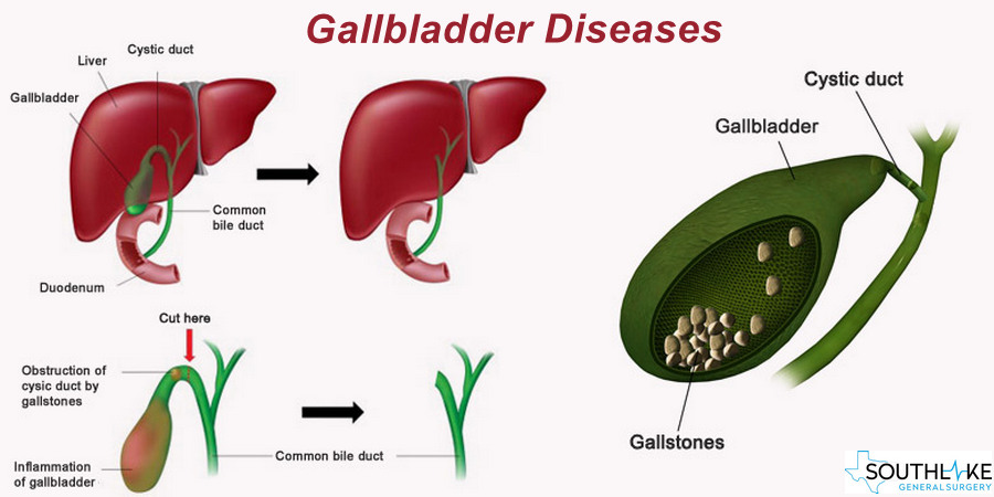 Symptoms Of A Gallbladder Problem Symptoms Tips - vrogue.co