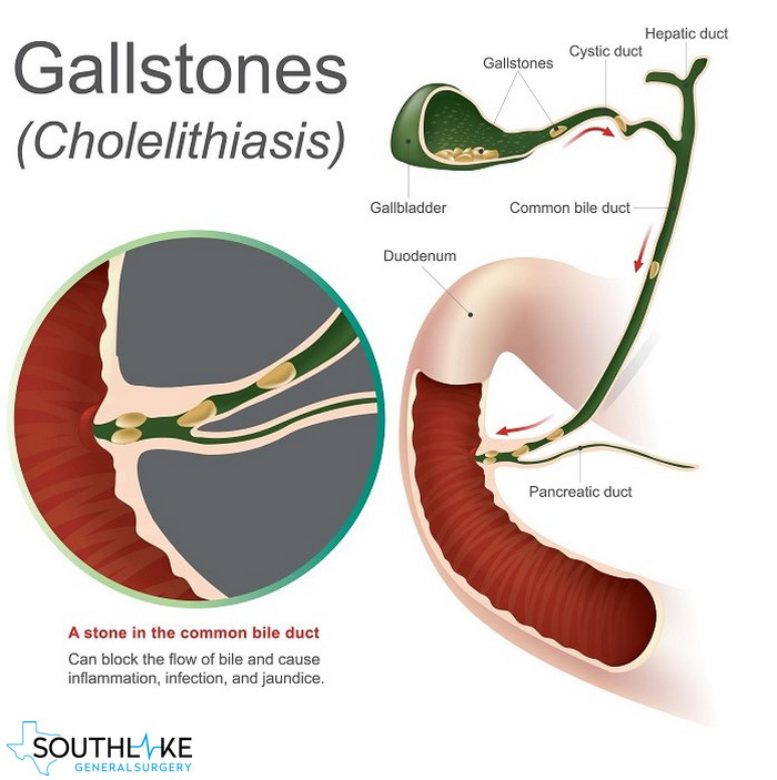 gallstones-define-problems