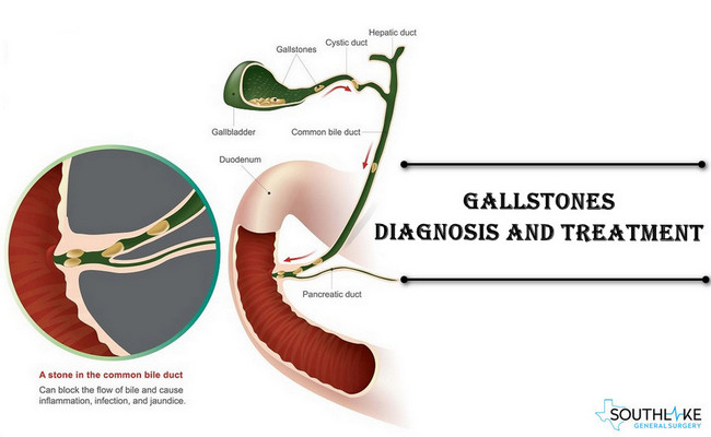 gallstones-treatment