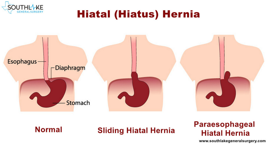 hiatal hernia