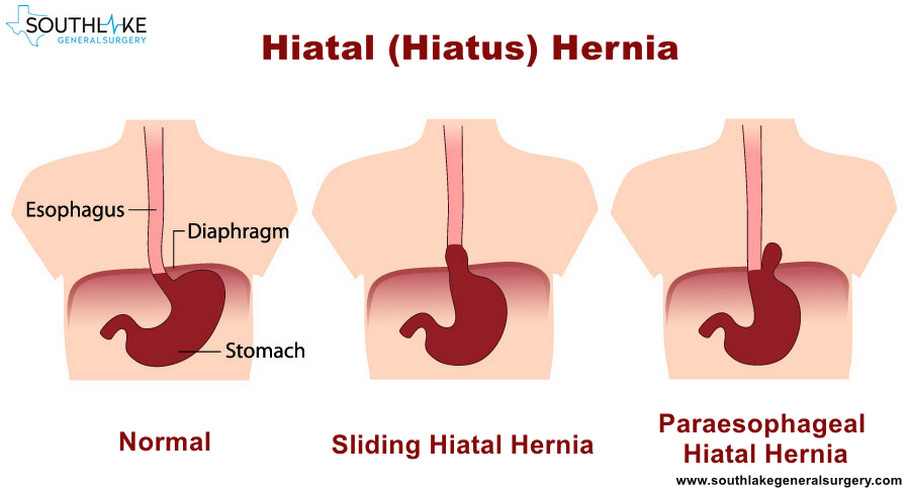 Hiatal Hernia- Causes, Types, Symptoms, Diagnose and Treatment | Texas