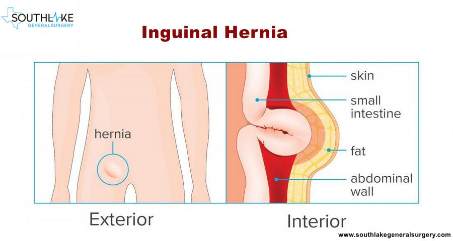 Right Inguinal Hernia Repair (Male Patient) 