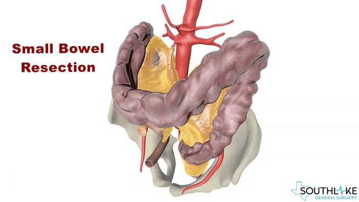 small_bowel_resection
