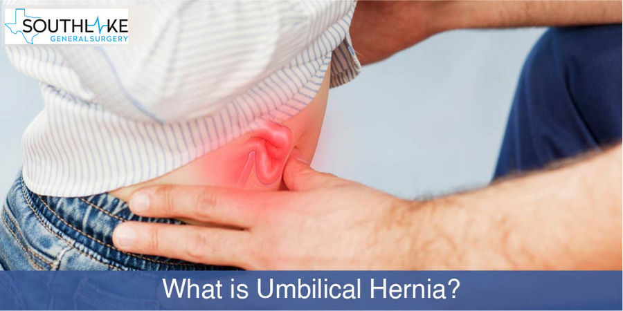 umbilical-hernia-southlake