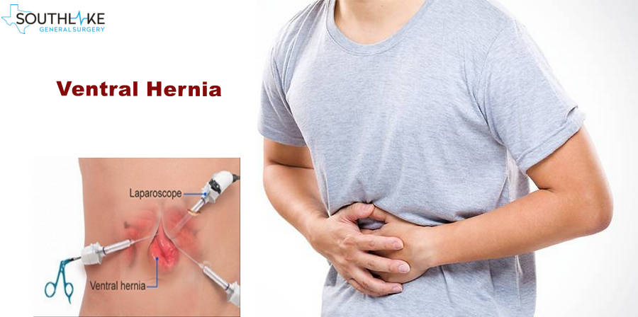 abdominal hernia in adults