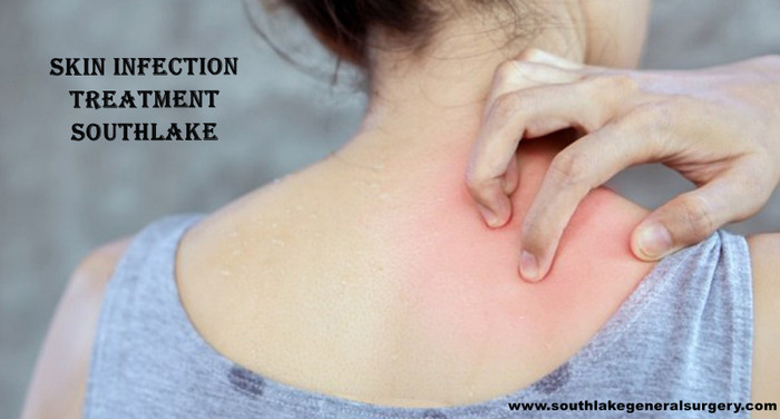Skin and soft-tissue infections (SSTIs)