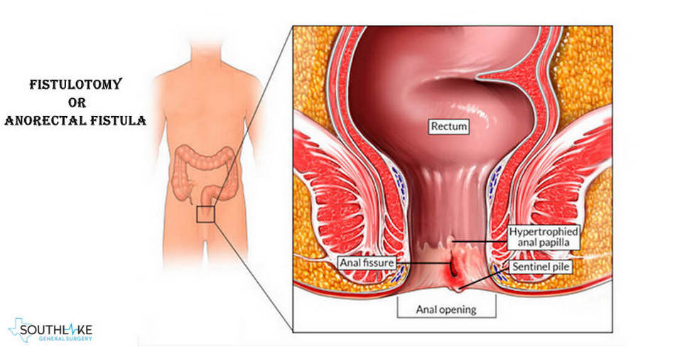 Anal treatment procedure