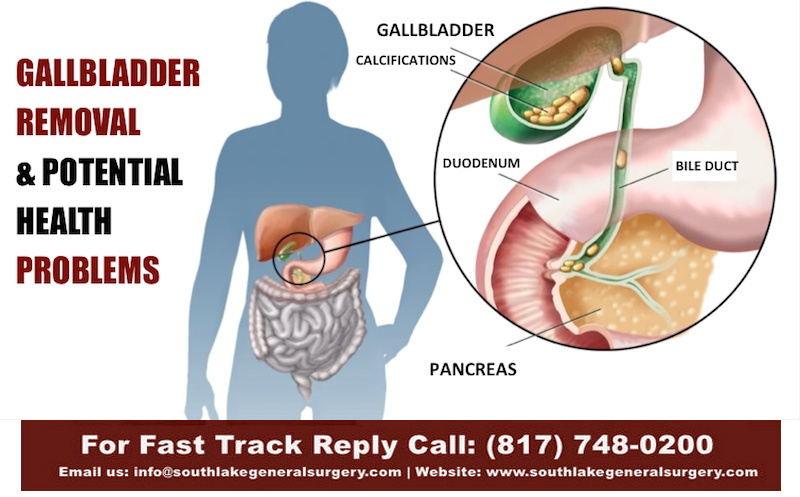 Gallbladder Surgery Southlake