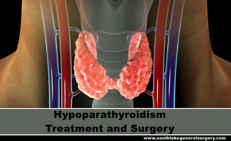 hypoparathyroidism-surgery