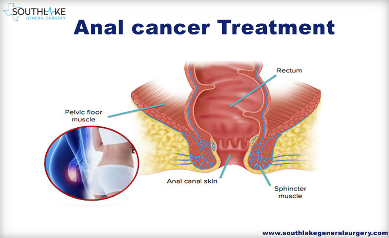 ATTACHMENT DETAILS Anal-Cancer-surgery-southlake