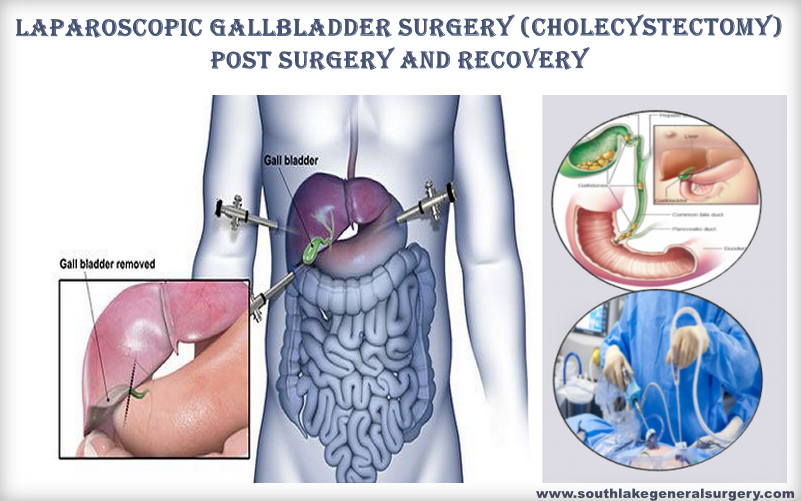 Gallbladder Post Surgery Effects And Recovery Southlake General Surgery
