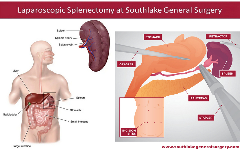 Laparoscopic-Splenectomy-southlake-texas