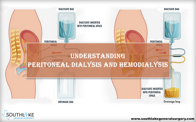 know-more-about-Peritoneal-dialysis