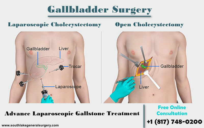 gallstone-Surgery-southlake