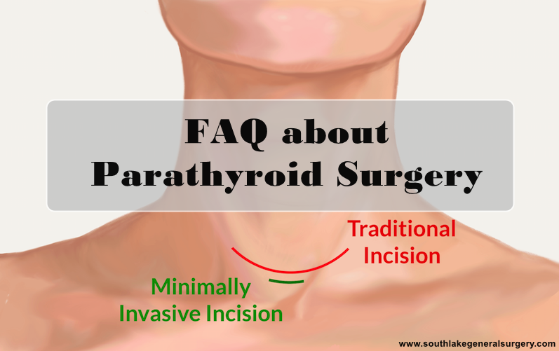 FAQ-about Parathyroid Surgery
