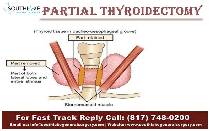 Partial thyroid removal surgery