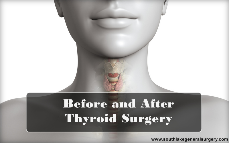 Before and after thyroid surgery @ southlake