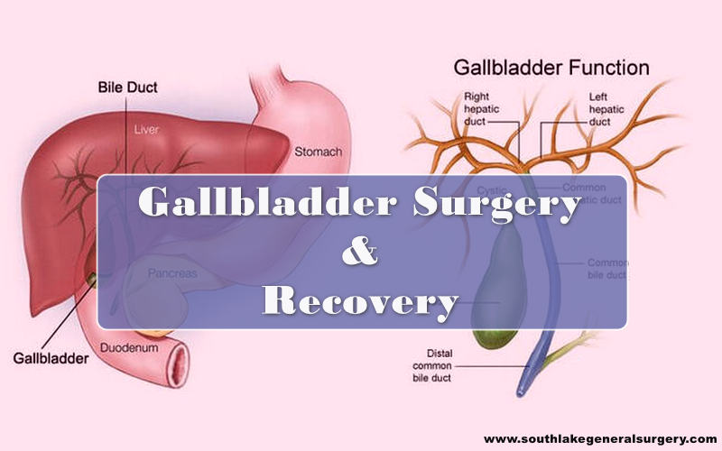 gallbladder-surgery-recovery