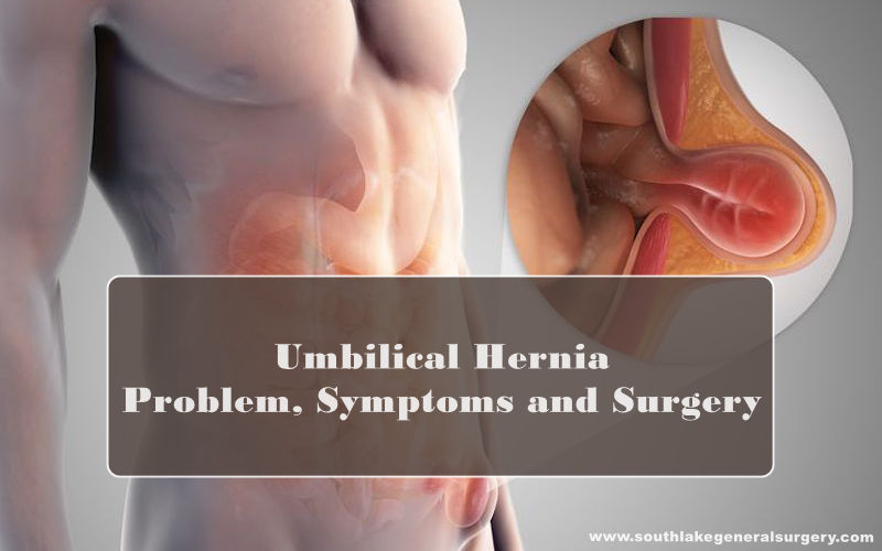 Umbilical Hernia - Symptoms and Surgery - Southlake General Surgery