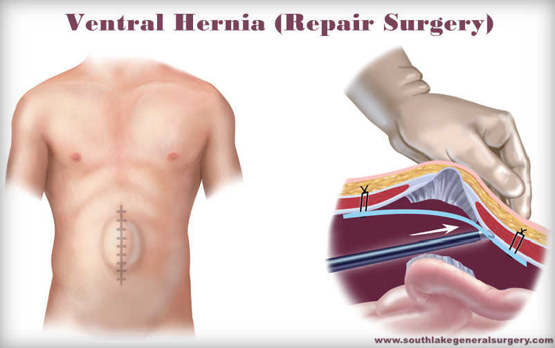 VentralHerniaRepair Surgery