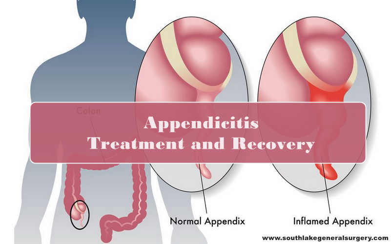 appendix pain in children