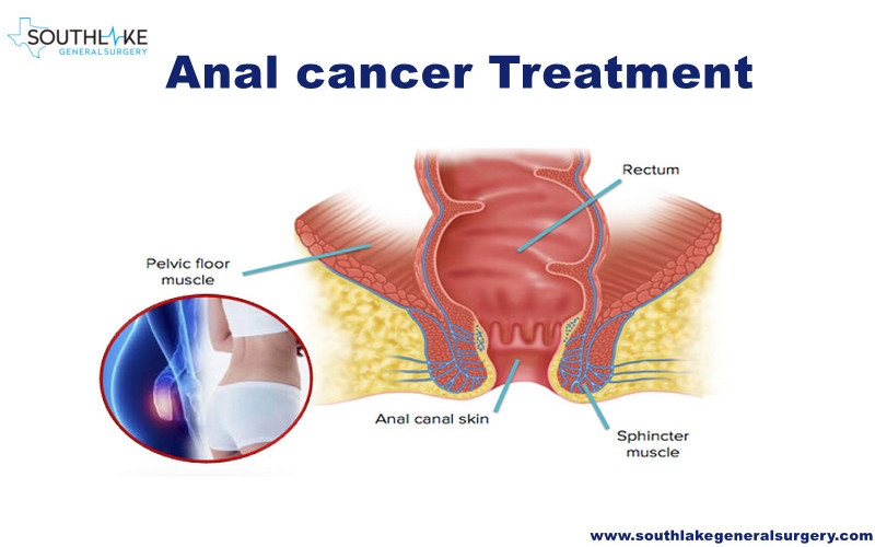 Anal-Cancer-surgery-southlake-texas