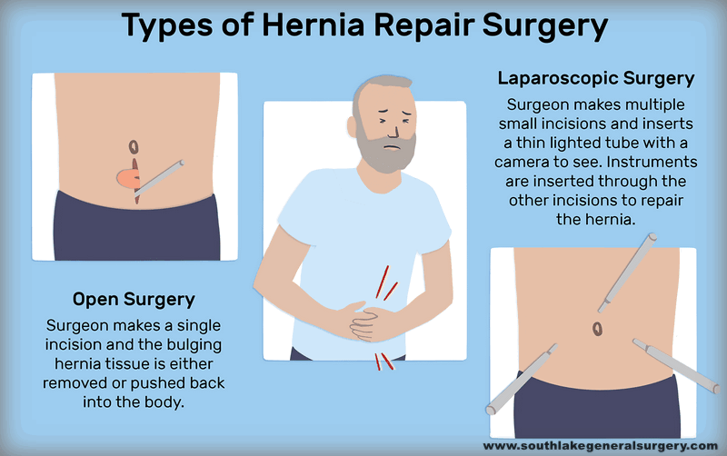 Types of hernia repair surgery are available to treat hernia at Southlake General Surgery, Texas, USA.