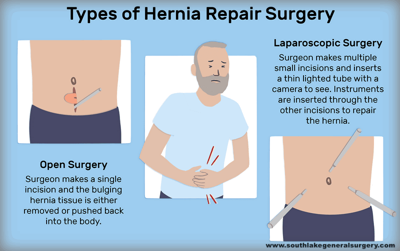 Femoral Hernia: Causes, Symptoms, Treatment