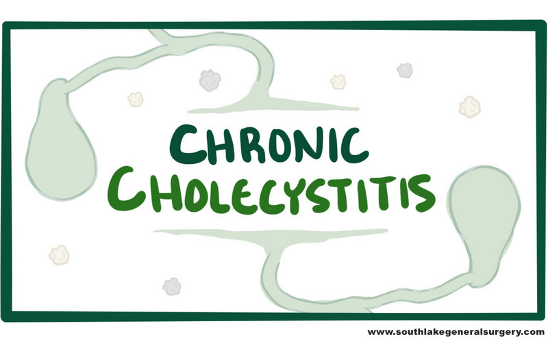 Chronic Cholecystitis- Causes, Symptoms, and Treatment