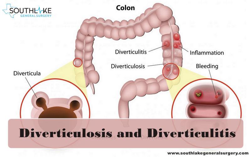Diverticulosis and Diverticulitis Southlake General Surgery